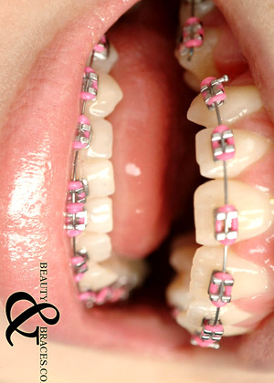 Beautyandbraces Beautyandbraces Model Comprehensive Mouth Premium Download