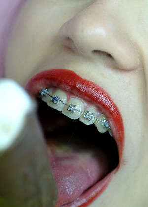 Beautyandbraces Beautyandbraces Model Rank High Metal Mouth Wifi Access